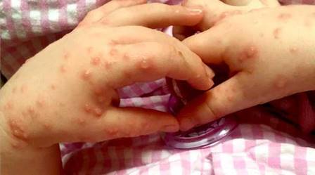 virus coxsackie 3006 virus coxsackie 3006