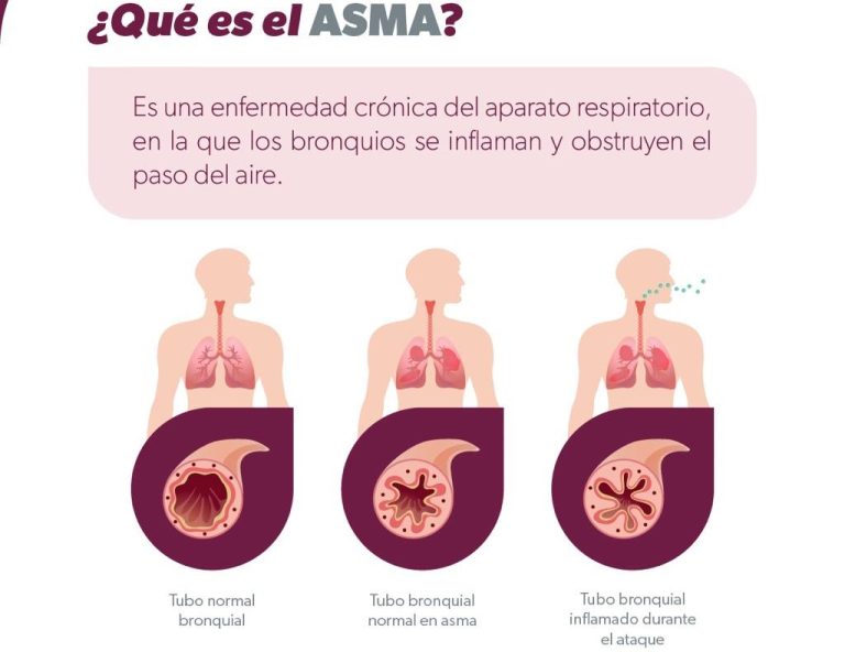 Emiten recomendaciones para cuidarse del asma en temporada invernal