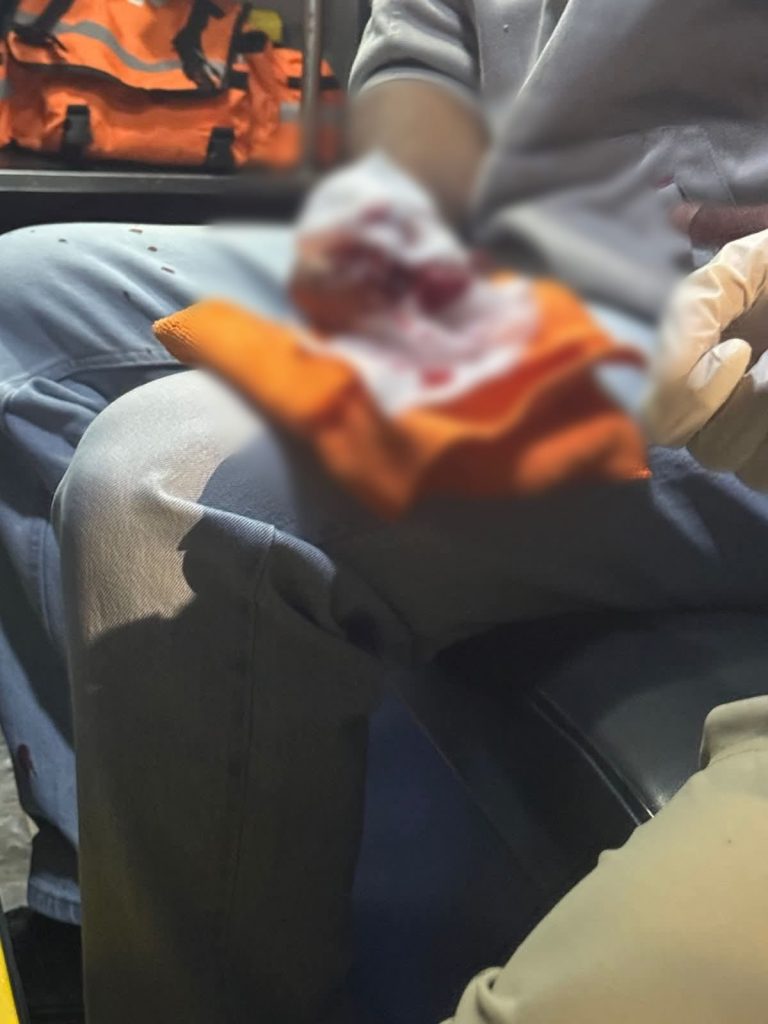 Hombre herido al estallarle pirotecnia en una mano, en Uruapan