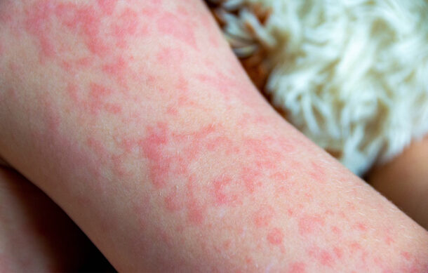 SSM llama a identificar los signos y síntomas de sarampión